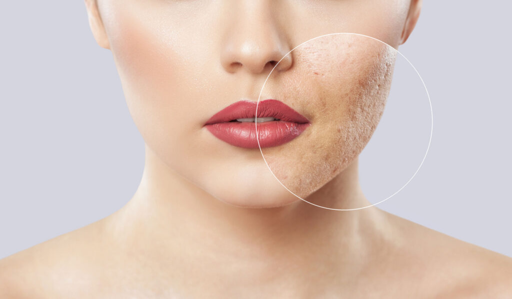 Tratamento Dermatológico da Acne: Soluções Eficazes para uma Pele Bonita