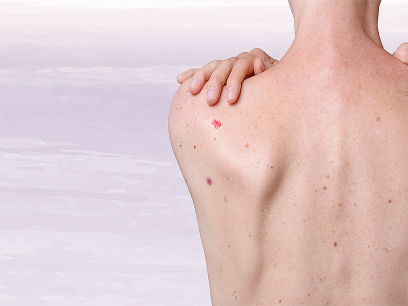 Câncer de Pele: Entendendo e Tratando com Abordagens Dermatológicas