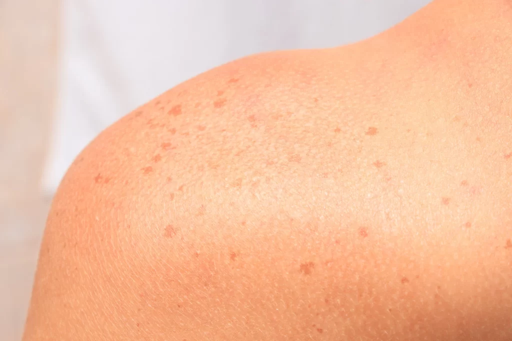 Combatendo Manchas de Pele: Tratamentos Dermatológicos e Seus Benefícios